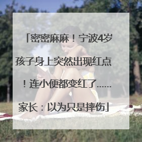 密密麻麻！宁波4岁孩子身上突然出现红点！连小便都变红了……家长：以为只是摔伤