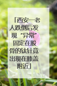 西安一老人跌倒后发现“异常” 固定在股骨的钛针竟出现在膝盖附近